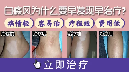 治疗儿童白斑的费用