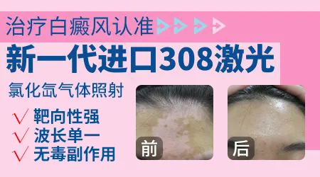 308准分子激光治白癜风多少钱