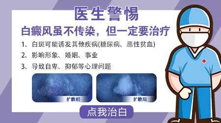 白癜风传染吗