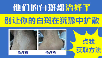 怎样才能治好孩子身上的白斑
