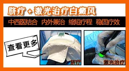 白癜风照308光多少次后无效需换方案