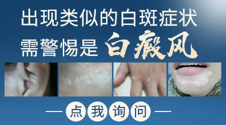 腿上长了一片白不疼也不痒怎么回事