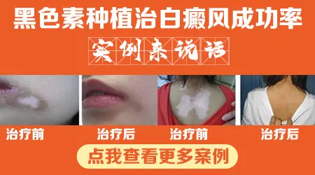 黑色素移植手术成功几率多少