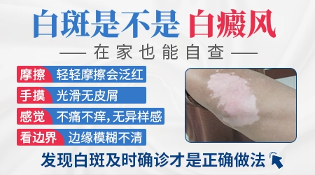 孩子脸上白斑是不是白癜风