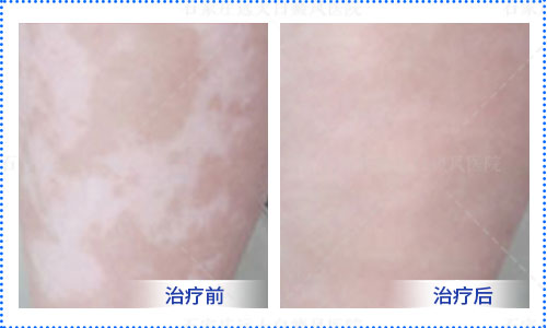 大腿根一块白斑是怎么了