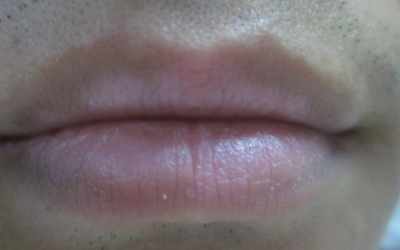 嘴唇白斑病早期图片