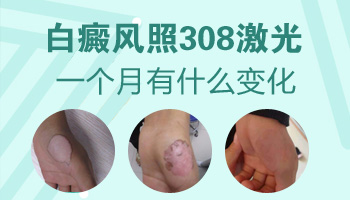 308激光治白斑多久有效果