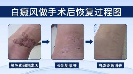 白癜风移植黑色素的费用