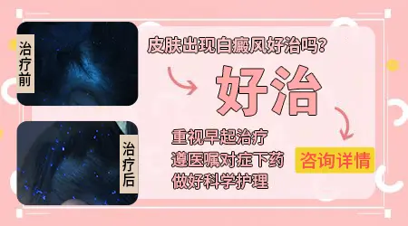 患有白癜风病好治疗吗