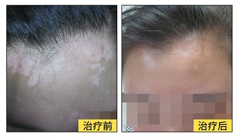 额头上的白癜风治好要多长时间