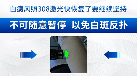 治疗白癜风308光疗仪什么牌子的好