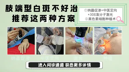 手部有白斑一般需要治疗多久