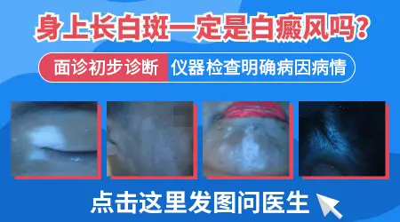 皮肤颜色变白是白癜风吗