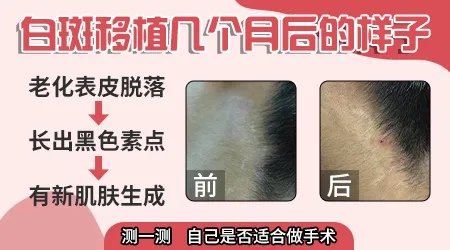 <a href=https://www.zhjianfa.com/mianbu/ target=_blank class=infotextkey>面部白癜风</a>植皮手术恢复图