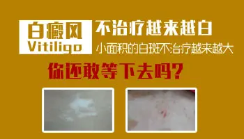 白癜风越来越白了是什么原因