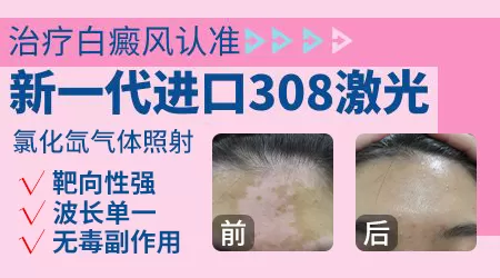 半岛308准分子治疗白癜风效果