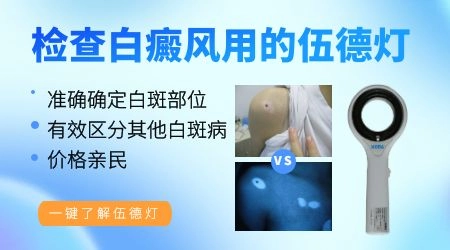 白斑像是白癜风做哪些检查