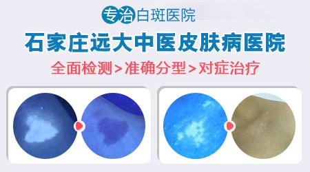 男孩身上白了一片是什么病