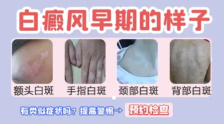 白癜风刚开始什么样子