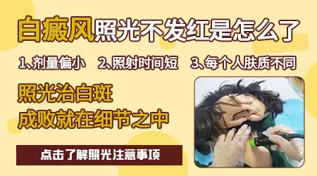 白癜风308激光多久照一次比较好