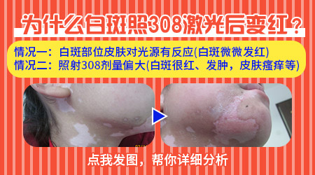 308准分子激光治疗白斑后变红正常吗