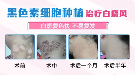 黑色素种植治白癜风效果好不好