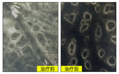 初期白癜风308激光后恢复变化图