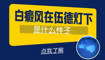 外伤后多久照伍德灯可以排除是不是白癜风