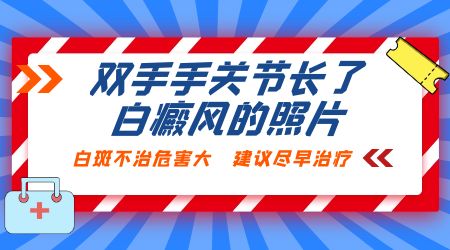 冬季白癜风不发展了可以不治疗了吗