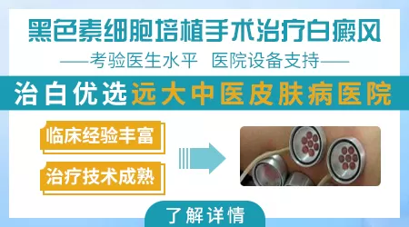 黑色素种植治疗白癜风哪家医院好