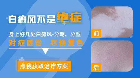 为什么白癜风很难好