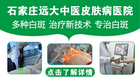 石家庄哪家医院治白癜风技术好