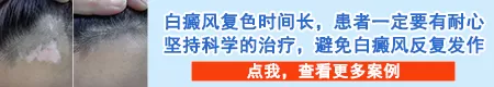 白癜风擦药后有好转迹象还需要照光吗