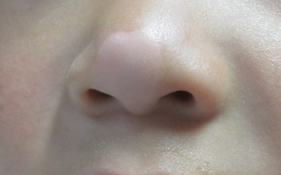 鼻子两边长白色的点点是什么东西