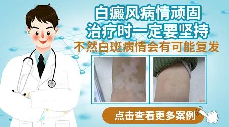 白斑扩散怎么能控制住