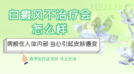 白癜风如果不治疗会怎么样