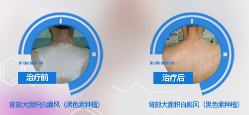 表皮移植手术治疗白癜风的价格明细