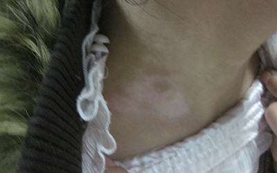 婴儿脖子皮肤有白点是什么