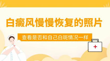 白癜风治疗3个月后一般会恢复成什么样