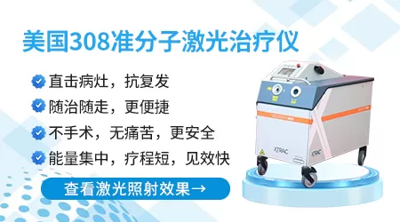 什么类型的白癜风照激光比较有效
