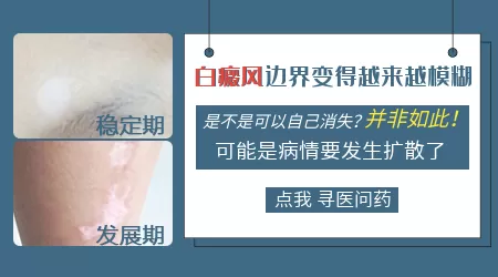 白癜风散开边缘不清晰怎么回事