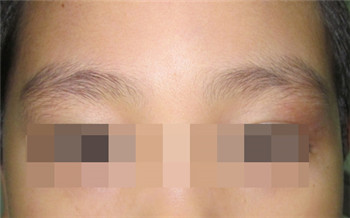 眼皮眼角对称小白斑是什么原因