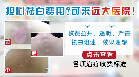 治疗白癜风花费多少钱