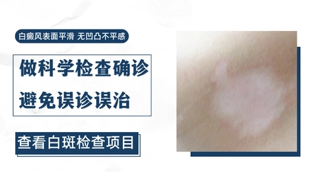 手上有白斑怎么回事 长白点的原因