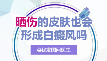 太阳晒脸上长白块是白癜风吗