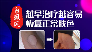 白癜风的治疗费用贵吗