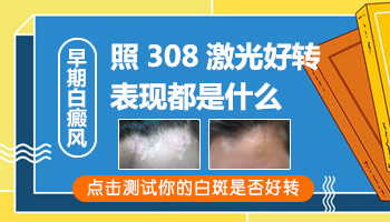 美国308激光准分子照白癜风多久照一次