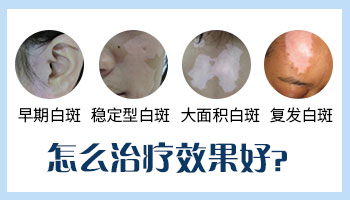 12岁女孩腰部长白斑两月了怎么治