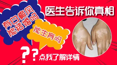 白癜风治疗期间可以生育吗