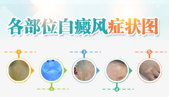 孩子大腿有块皮肤颜色较浅发白